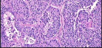 Large Cell Neuroendocrine Tumor
