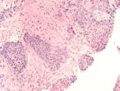 Squamous Cell Carcinoma Nests of tumor cells Dense cytoplasm No mucin