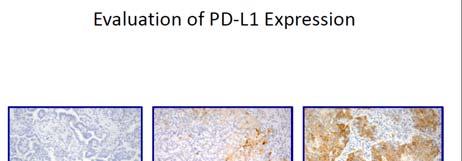 PD-L1 expression in >5% of tumor cells or immune cells, IHC1/2/3