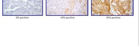 immune cells, IHC0 (TC0 and IC0), PD-L1 expression in <1% of