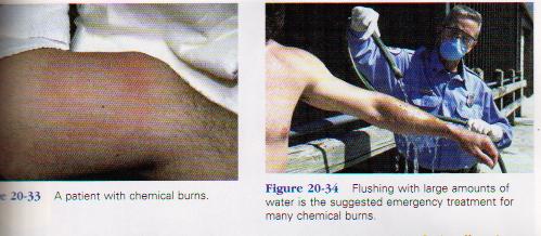 a burn injury To estimate the severity