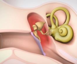 6 Types Of Hearing Loss Conductive hearing loss Problems in the outer or middle ear that prevents