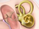or damaged sensory cells (hair cells) in the cochlea Usually permanent Hearing aids, Middle ear