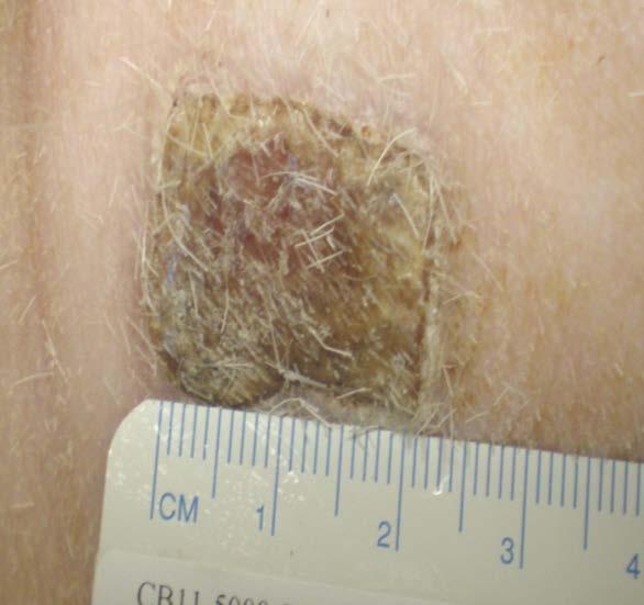 inflammation is present in the wound bed