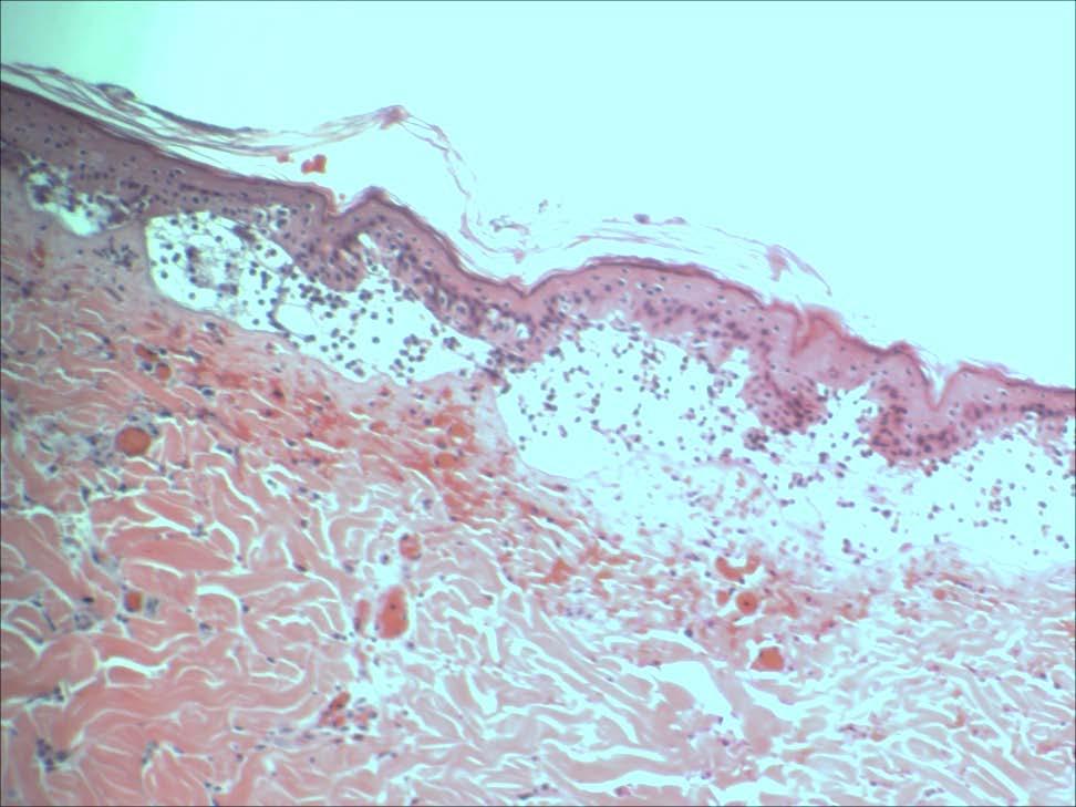 Histology, full thickness, with loss of epithelium-2 days Full thickness burn, 2 days.