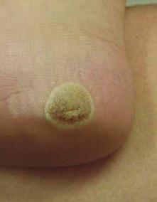 Philadelphia, PA: Lippincott Williams & Wilkins; 2009. verruca vulgaris. They re typically found on the fingers, but can be located on any skin surface. Common warts vary in shape and size.