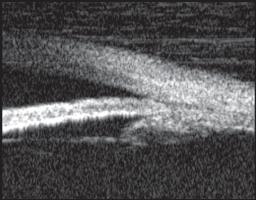 Clinical Applications of Ultrasound Biomicroscopy in Glaucoma Plateau Iris Syndrome In plateau iris syndrome, UBM usually reveals an abnormally steep anterior angulation of the peripheral iris,