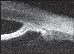 23 Garudadri CS et al 24 evaluated the presence of plateau iris in eyes with primary angle-closure glaucoma (PACG) after laser peripheral iridotomy by gonioscopy and ultrasound biomicroscopy and the
