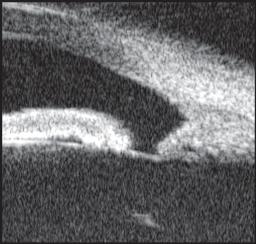 Clinical Applications of Ultrasound Biomicroscopy in Glaucoma Fig. 12: Iridodialysis Fig.