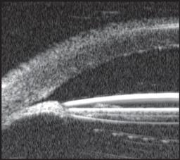 (Fig. 14). Secondary Glaucoma after Retinal Surgery UBM can be used to evaluate angle changes post vitreoretinal surgery. Genovesi-Ebert et al 33 used this technique in the Fig.