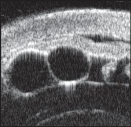 distance between the lens and the ciliary process at the site of subluxation and forward movement of the lens.