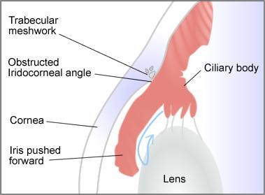 both eyes affects around 25% of patients (around 4 million people) with angle closure glaucoma worldwide. In western countries around 10-15% of glaucoma is due to angle closure. Figure 3.