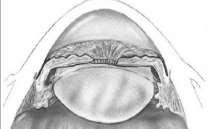 The axial lens thickness is greater than in normal subjects, and the thicker