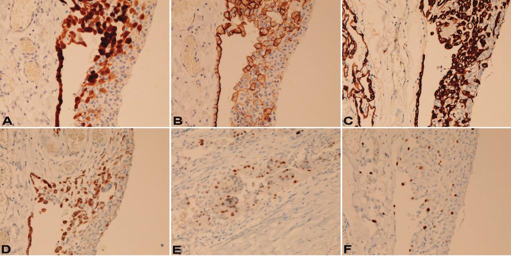 Immunohistology of histiocytic/mesothelial hyperplasia Figure 3. A. The patch (right) is positive for calretinin. The mesothelium (left) is also positive. Immunostaining, x200. B.