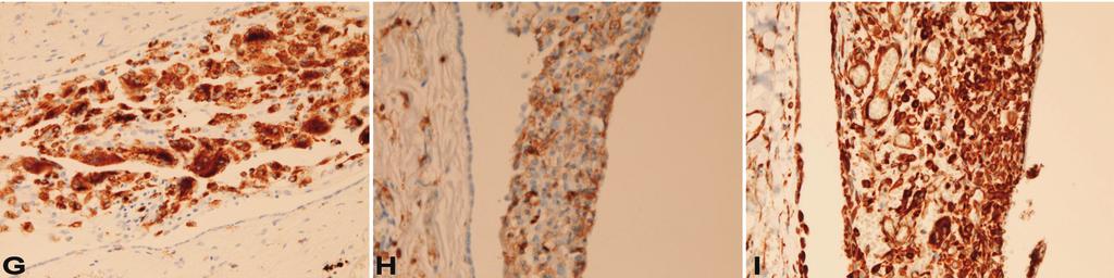 The mesothelium (left) is also positive. Immunostaining, x200. D. The patch (right) is positive for cytokeratin 5/6. The mesothelium (left) is also positive. Immunostaining, x200. E.