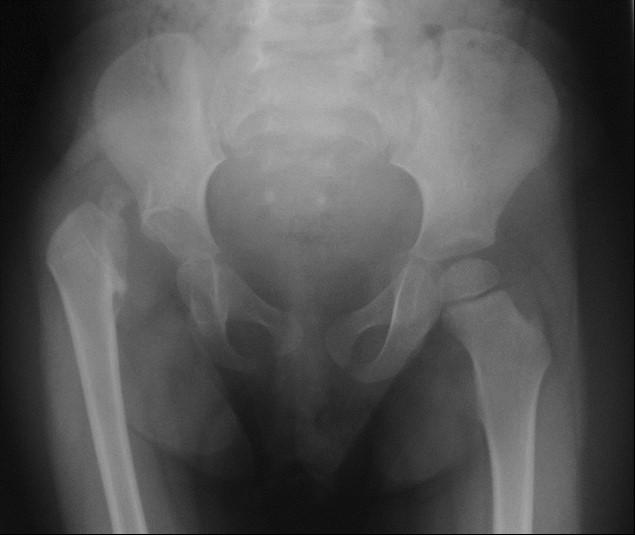 Treatment of Septic Hip Dislocation with a Preserved Femoral Head Med & Health Dec 2017;12(2): 335-340 (a) (b) Figure 1: a) Radiograph showing pathological right hip