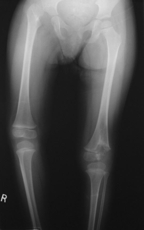 unossified as a result of knee sepsis during infancy. Figure 2: Intraoperative photograph of the deformed right femoral head with erosions of the overlying cartilage.