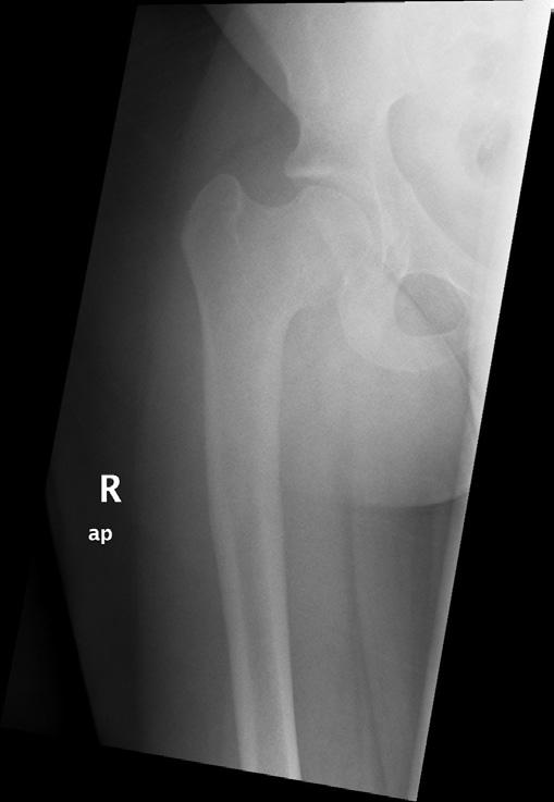 Med & Health Dec 2017;12(2): 335-340 Kamal J. et al. (a) (b) (c) Figure 3: a) Radiograph of the hip after 11 years.
