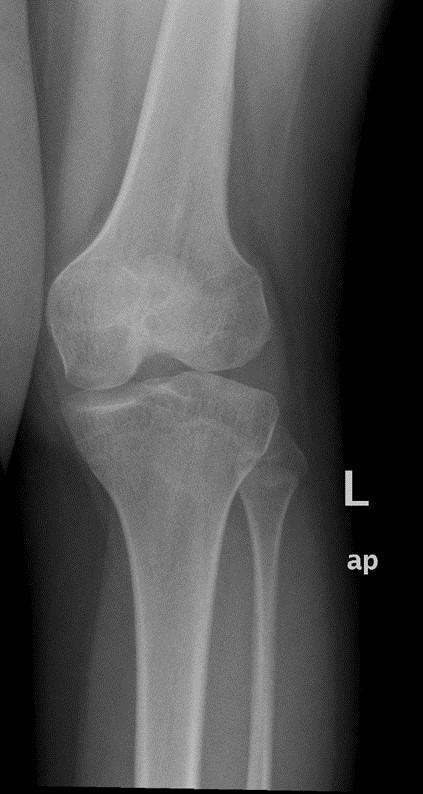 child at the age of 13 years. septic arthritis of various joints for at least 2 years and found 12 of them had no severe sequelae.