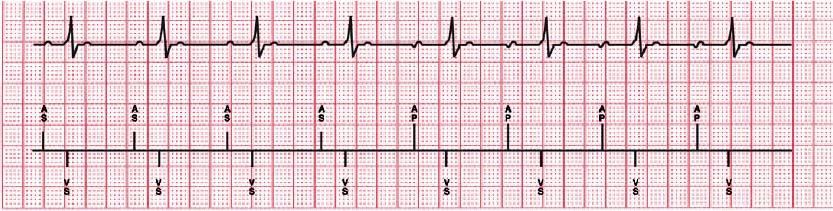 MVP Basic Operation AAI(R) Mode Atrial based pacing allowing intrinsic AV conduction PR Intervals are only