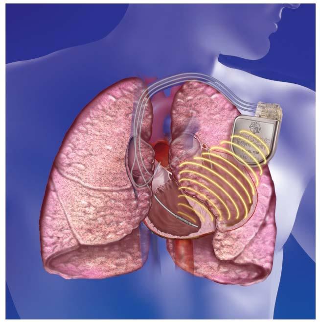 Concept As pulmonary congestion clears,