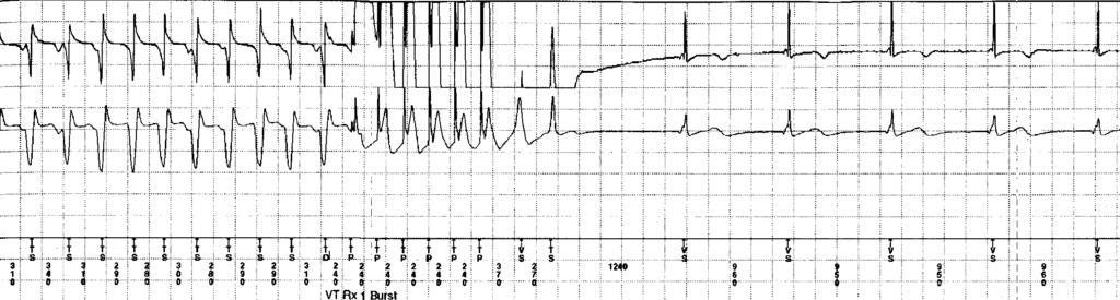 Programming of Tachycardia Parameters: Minimise Shocks C. W. Israel, M.D.