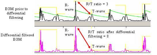 Avoid T Wave Oversensing large R waves at implantation dedicated programming options Sensitivity Threshold after VP Reduction of