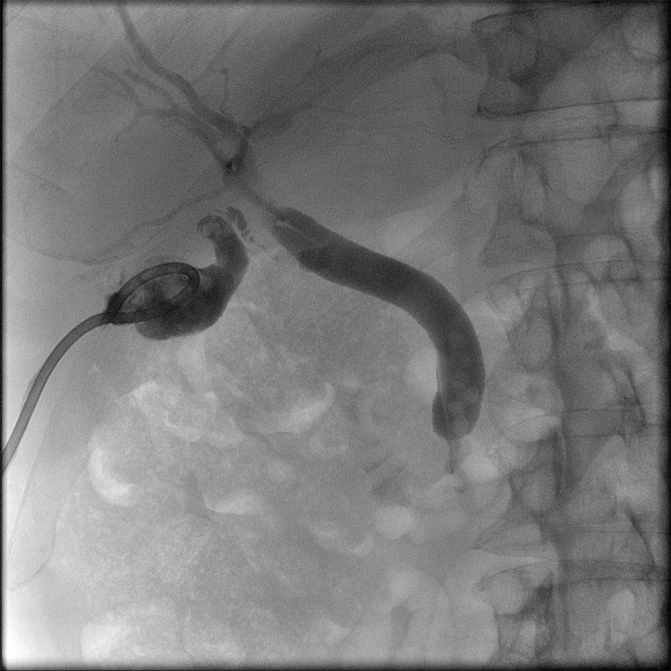 N. Hersey et al.: Stenting of the Cystic Duct 965 Fig. 1 A tubogram performed through existing transhepatic percutaneous cholecystostomy recurrence of acute cholecystitis of 35 and 46 %, respectively.