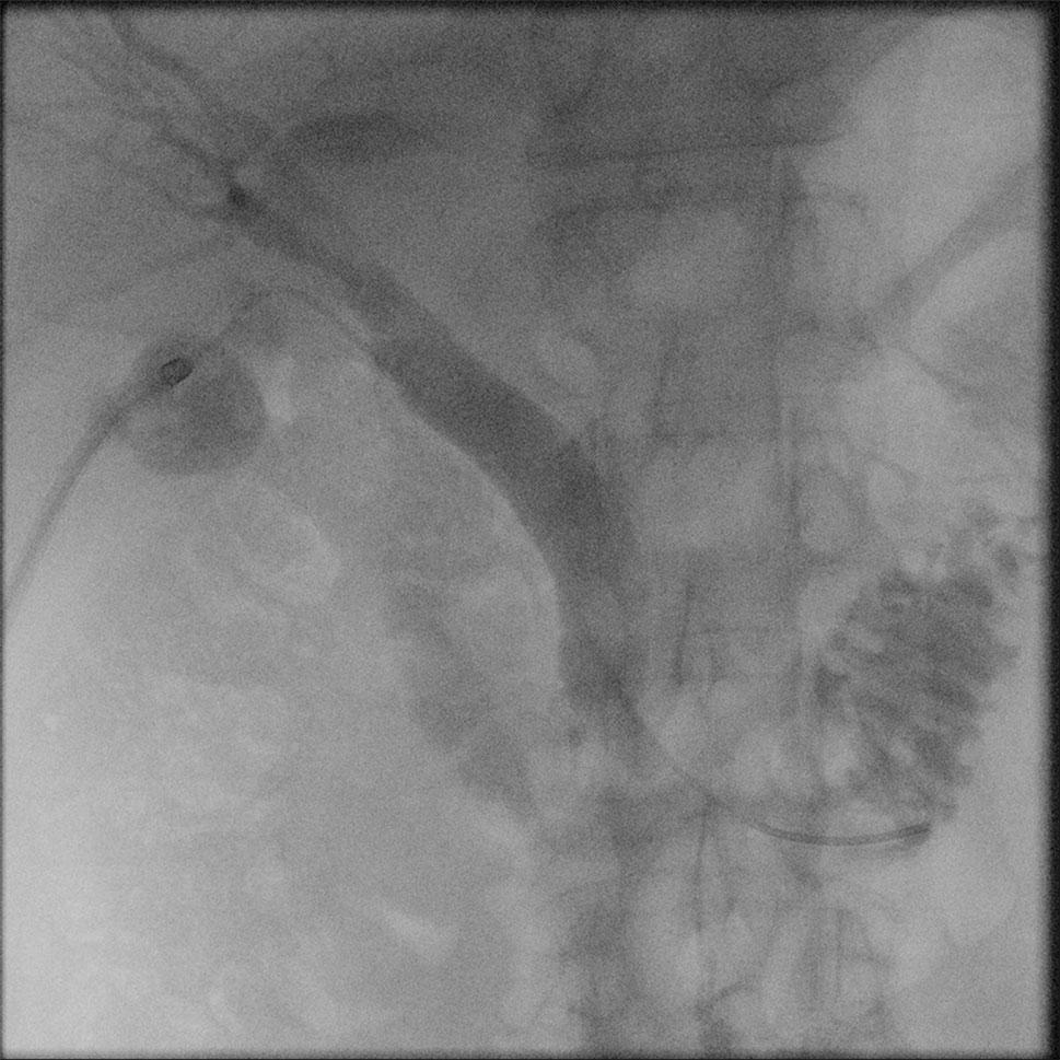 Cystic duct stent insertion therefore provides an alternative for these patients, and we present a case series of patient undergoing this novel new therapy. Fig.