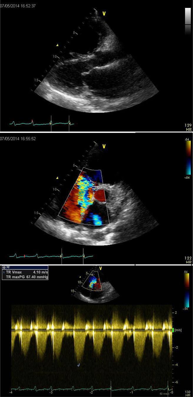 Wang et al. BMC Cardiovascular Disorders 2014, 14:149 Page 2 of 5 Case presentation A 75-year-old woman was presented to our hospital with 10 years of mild exertional dyspnea and palpitation.