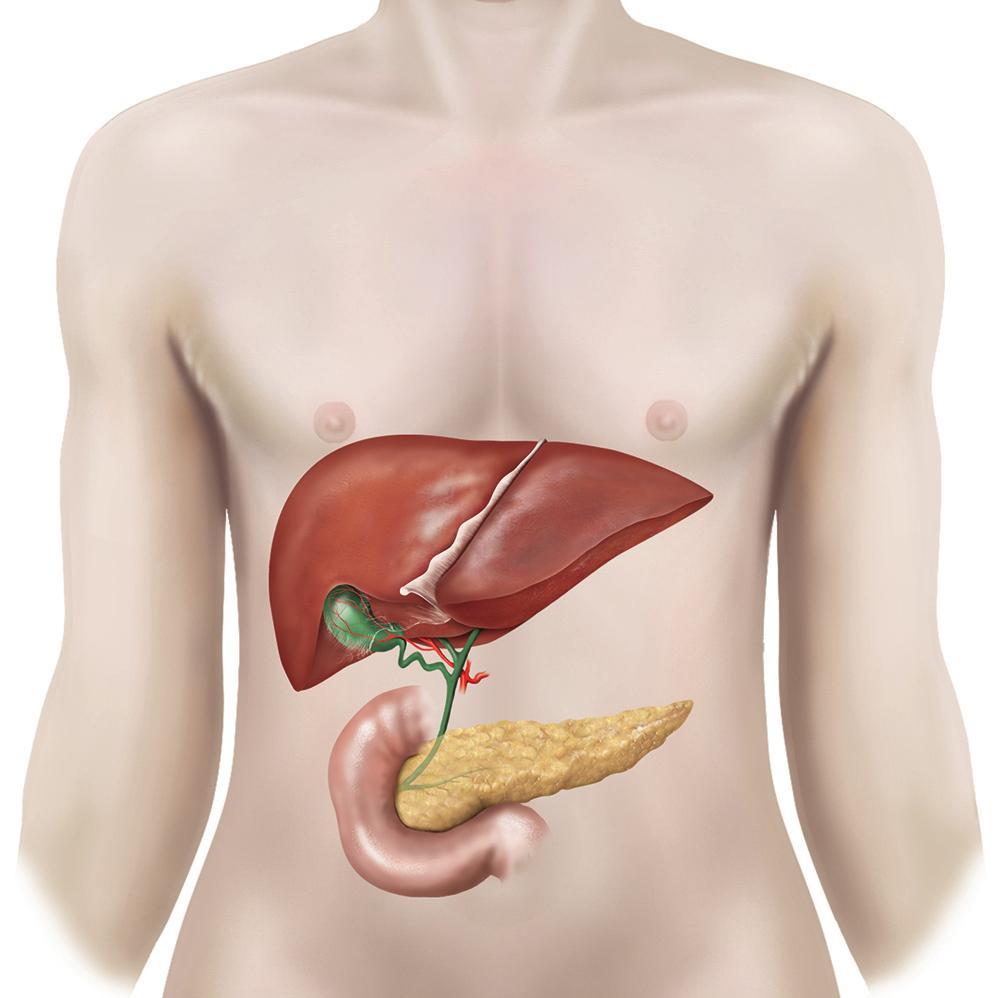 What are gallstones? Gallstones are stones that form in your gallbladder (see figure 1). They are common and can run in families.
