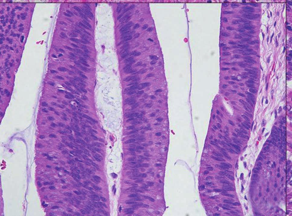 6 PanIN-1 was defined as flat epithelial lesions composed of tall columnar cells with basally located small round to oval nuclei and abundant supranuclear mucin.