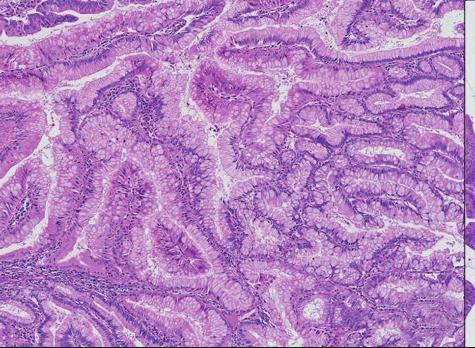 Resection Margin of Pancreatic IPMN 413 C D Fig. 3. Epithelial types of pancreatic intraductal papillary mucinous neoplasm. () Gastric type, () intestinal type, and (C, D) pancreatobiliary type.