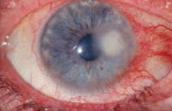 injection White lesion on the cornea