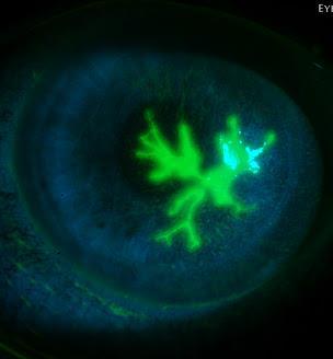 Viral Infective Keratitis HSV vs VZV Clinical features Dendritic ulcer or geographic ulcer Terminal bulbs Stromal