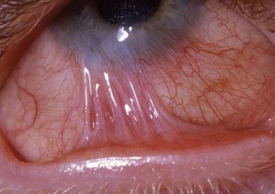 Chemical Injury Ocular emergency Acid vs