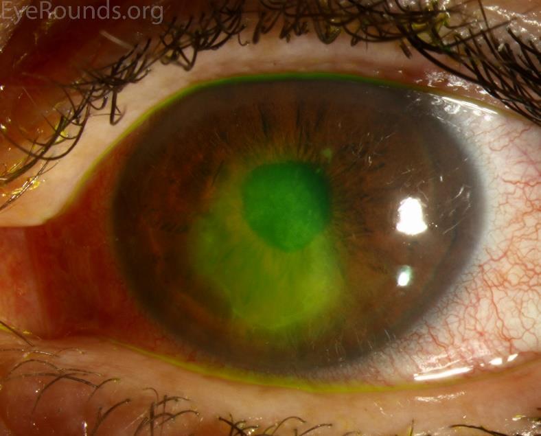 Corneal Abrasion / Recurrent Stain with Fluorescein Pain on waking up Corneal Erosion Poor