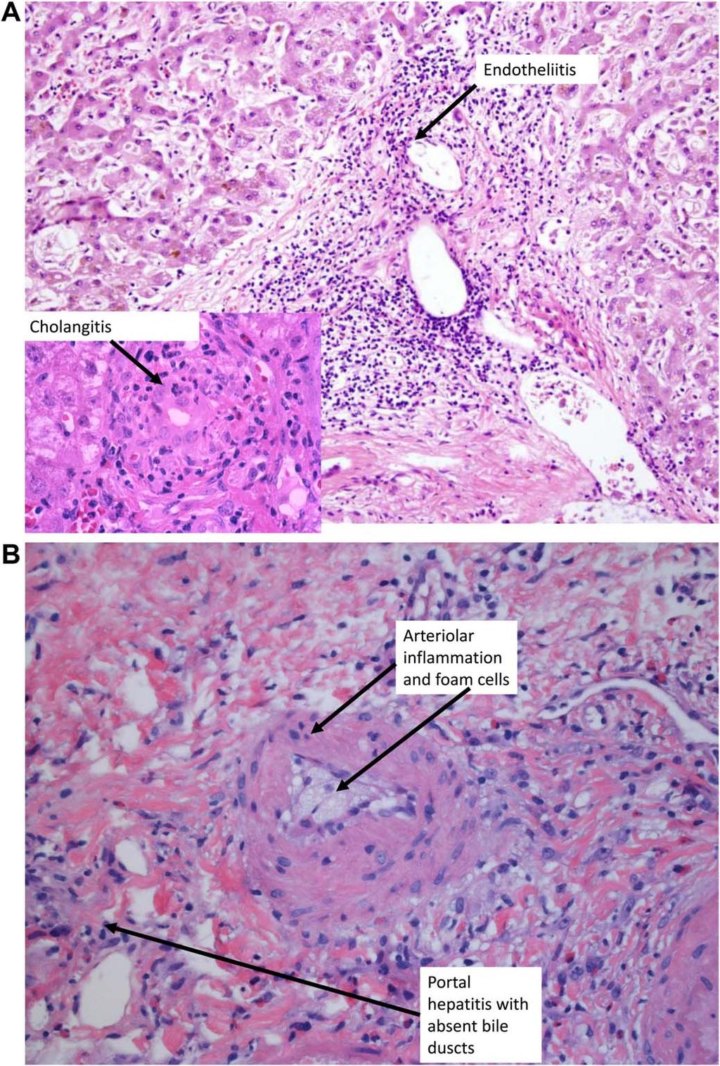 FIG 2 (A) Hematoxylin and eosin stain of liver biopsy obtained on the seventh postoperative day.