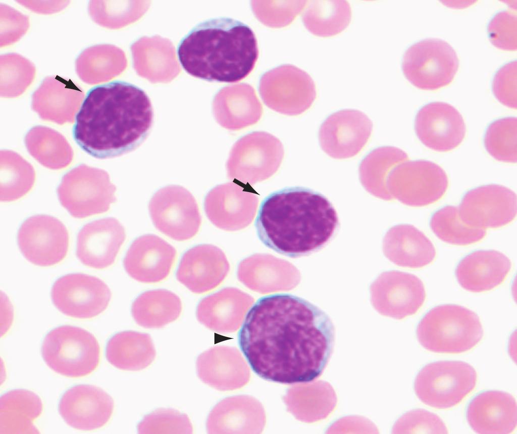 Chakhachiro et al / B-Lymphoblastic Leukemia in Chronic Lymphocytic Leukemia A B Image 1 Findings for patient 1.