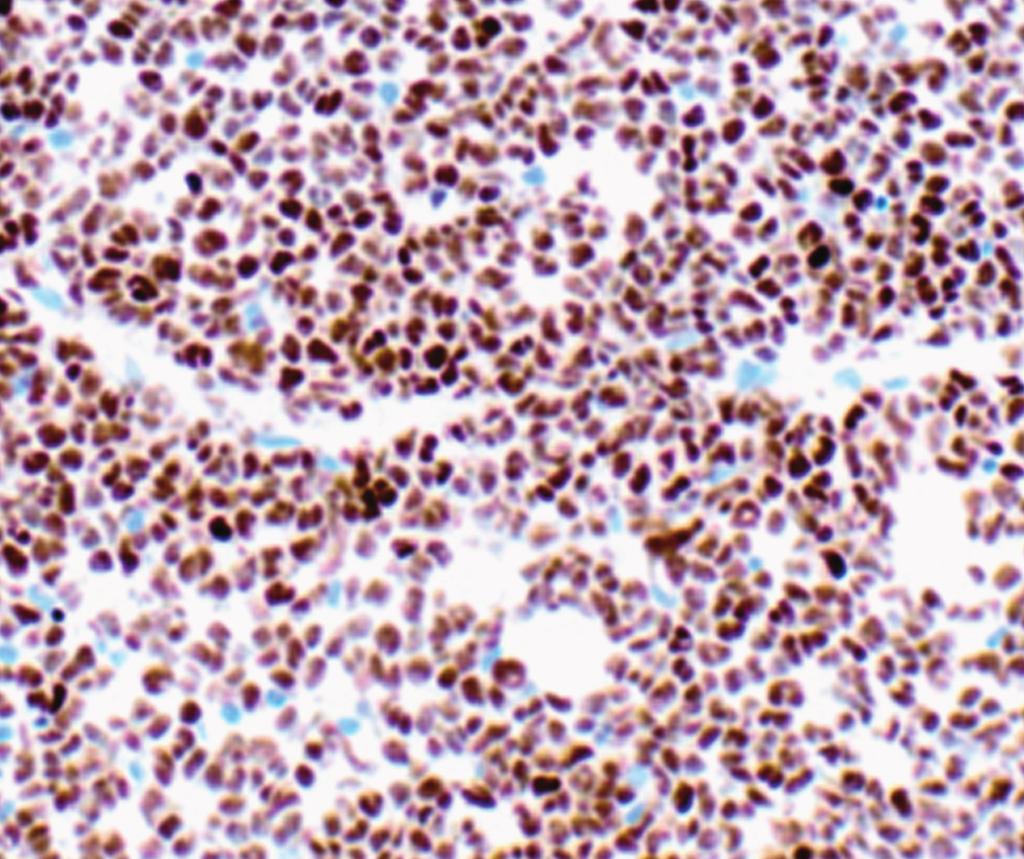 with occasional intermixed smaller lymphocytes (H&E,