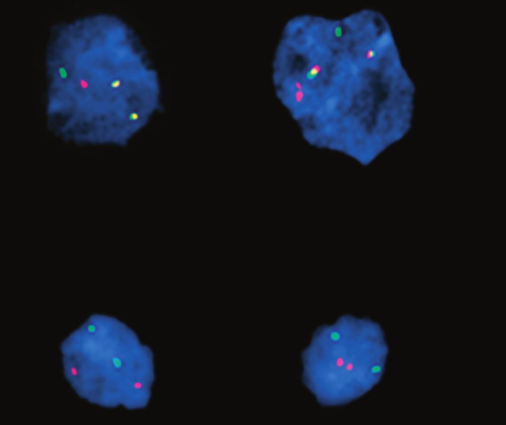 BCR-ABL1 by fluorescence in situ hybridization