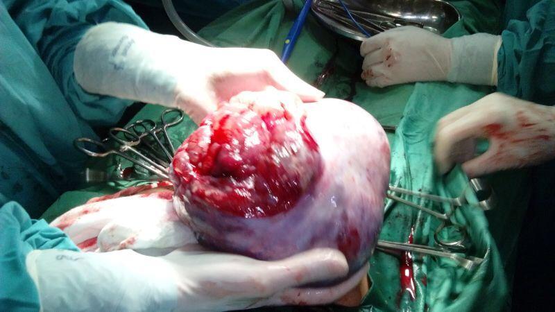 Simple ovarian cysts do not usually become malignant.