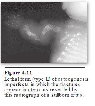 Mild form: bone fragility, hearing loss, and blue sclera Severe