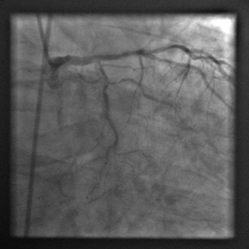 Cardiac Catheterization Images