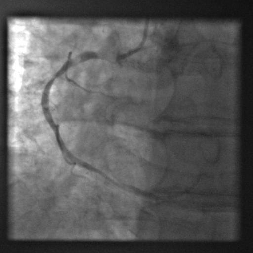 Mr. O s Cardiac Catheterization Images RCA