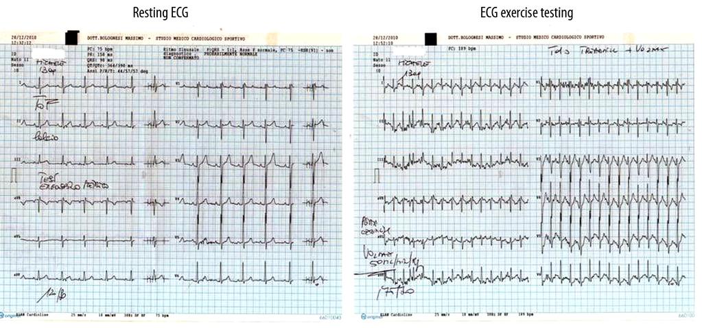 Figure 2. Resting ECG and during exercise testing show normal pattern. Figure 3. 2D Trans-thoracic echocardiography show mild right ventricular enlargement and mild tricuspid regurgitation.