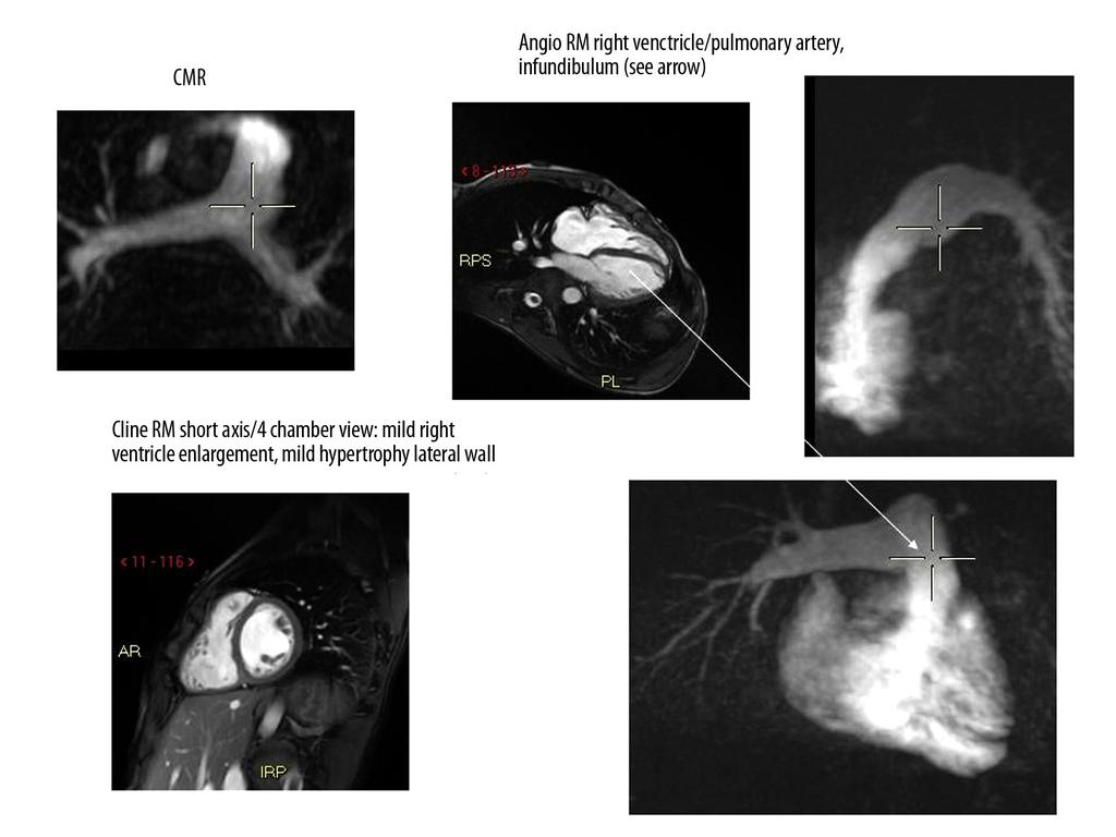 Figure 4. Cardiac MRI reveals slight dilation with hypertrophy of the right ventricle and shows the infundibular region of the right ventricular outflow tract.