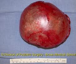 occur Large cysts can lead to ovarian