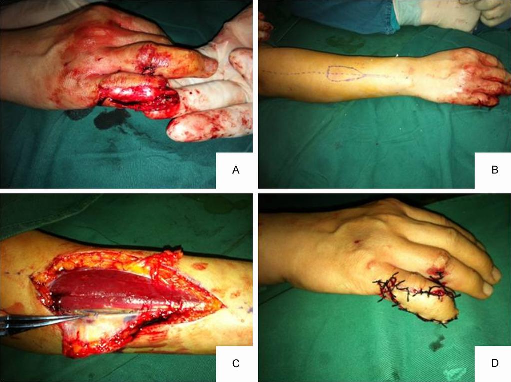 Figure 1. A. Right little finger injury. B. Forearm interosseous artery flap design. C. Determining skin-perforating vessels in the flap. D. At 10 d, the flap had survived.