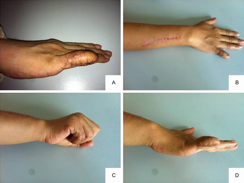 Figure 2. A, B. At 6 months after the operation, appearance of the flap and of the forearm donor site. C, D. At 6 months, right little finger flexion and extension activities recovered well.
